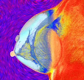      Imagerie par Résonance Magnétique ( IRM ) montrant une implantation de prothèse mammaire. Une capsule de vitamine E ( à gauche ) a été placée sur la surface du sein pour indiquer l'emplacement d'une anomalie suspectée. 