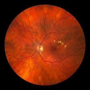 Un fond d’œil doit être effectué chez tout patient à risque avant intensification thérapeutique