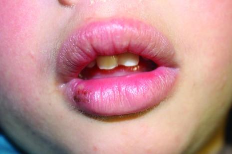 Cliché 1 Œdème des lèvres avec fissuration