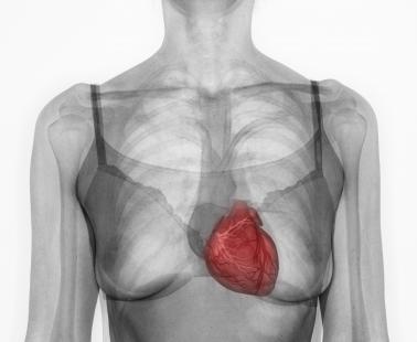 Les maladies cardiovasculaires sont la principale cause de mortalité chez la femme en France