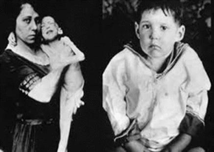 Leonard Thompson, 14 ans, hospitalisé depuis le 2 décembre 1921 à la phase cachectique du diabète, premier bénéficiaire de l’injection d’un extrait de pancréas bovin préparé par James Collip le 23 janvier 1922