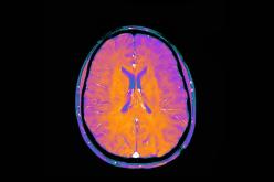 Alzheimer : des biomarqueurs retrouvés 18 ans avant la maladie