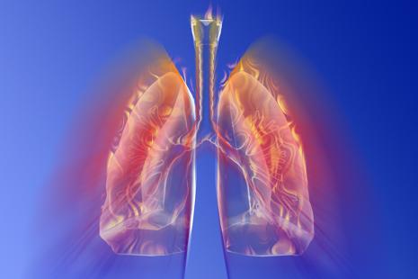 Une forme grave de la maladie qui affecte 3 à 6 % des asthmatiques