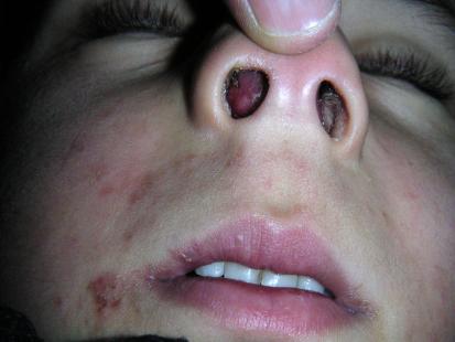 Écoulement nasal nauséabond chez un enfant de 4 ans | Le Quotidien ...
