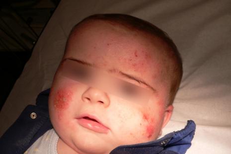 La dermatite atopique concerne le nourrisson à partir de deux mois