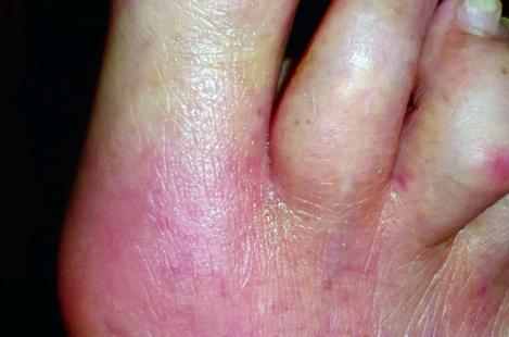 Inflammation de la 1re métatarso-phalangienne du pied droit suite à des instillations endovésicales de BCG.