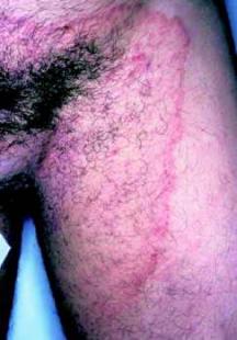 Lésions des plis inguinaux chez un cycliste : intertrigo mycosique à  dermatophytes | Le Quotidien du Médecin