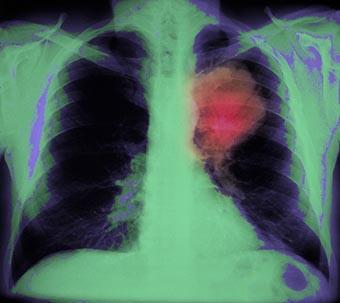 visuel cancer du poumon