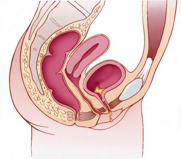 incontinence urinaire schéma pelvis