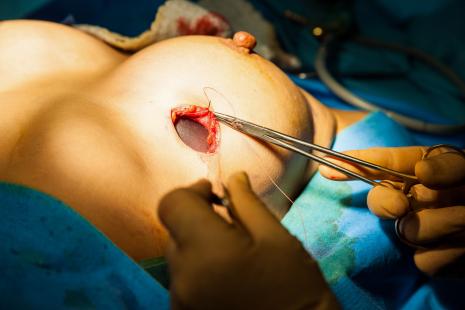 La pose de prothèses mammaires fait partie des chirurgies les plus génératrices de douleurs
