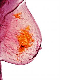 Certains cancers du sein sont liés à BRCA 1/2