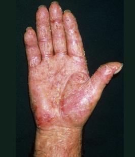 Dermatite atopique