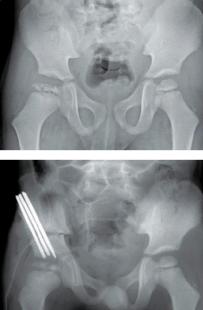 Ostéotomie de bassin sur une ostéochondrite de hanche droite la radiographie préopératoire montre...