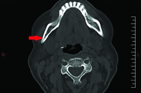 Apophyse styloïde longue (plus de 30 mm) à droite (flèche rouge) vue au scanner. 