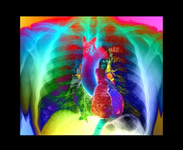 De nouvelles pistes thérapeutiques dans l’hypertension artérielle pulmonaire 