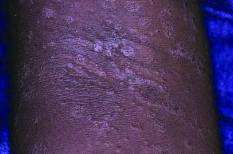 Pityriasis rosé de Gibert sur peau noire