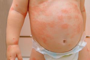 Les allergies alimentaires : les différentes manifestations ...