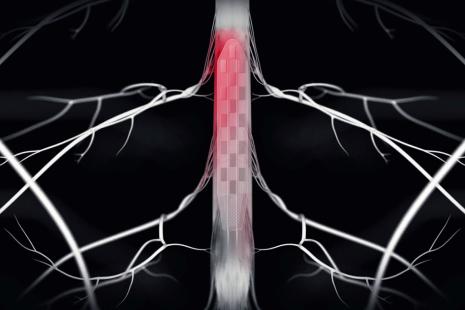 Contrairement aux traitements conventionnels de la maladie de Parkinson, cette neuroprothèse vise la zone de la moelle épinière responsable de l’activation des muscles des jambes pendant la marche