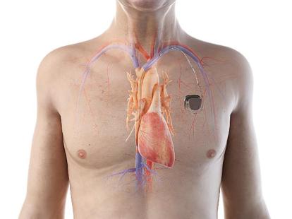 Thorax d'un homme avec un pacemaker ou stimulateur cardiaque. Il envoie au coeur des impulsions électriques qui lui permettent de battre régulièrement. Image de synthèse. 
