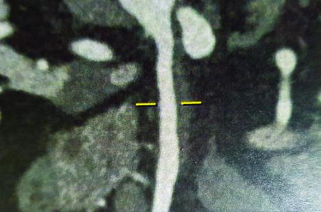 Épaississement pariétal (repères jaunes) lié à une dissection de l’artère mésentérique supérieure, vu à l’angio-scanner. 
