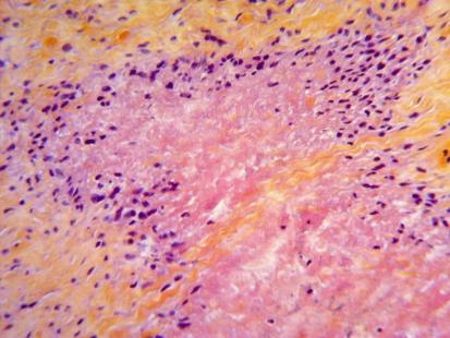 Coupe histologique : aspect de granule nodulaire profond ou de nodule rhumatoïde