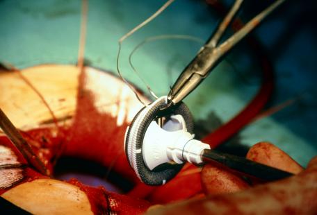 La chirurgie de remplacement valvulaire, dès le diagnostic posé, diminue la mortalité.