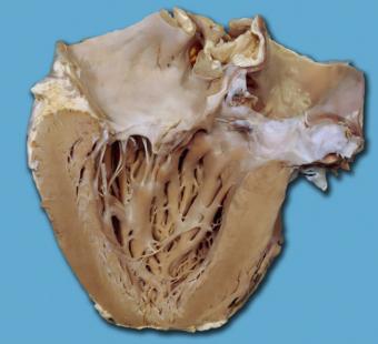      Coeur atteint de cardiomyopathie hypertrophique (CMH). 