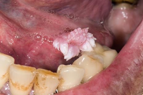 Papiloma virus bucal tratamiento