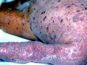 Le point sur l'herpès cutanéo-muqueux | Le Quotidien du Médecin